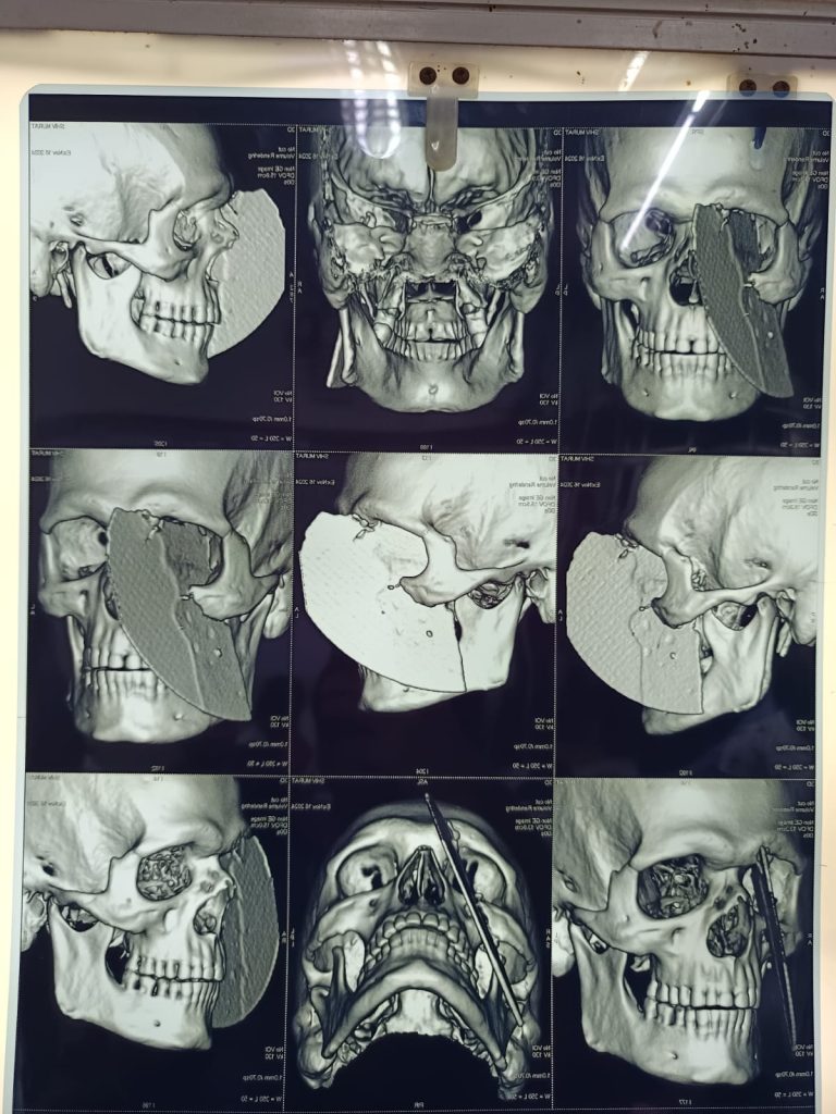 A mason in India survives a freak accident as a flying machine blade slices through his face. Discover the miraculous surgery and incredible fight to save his sight!