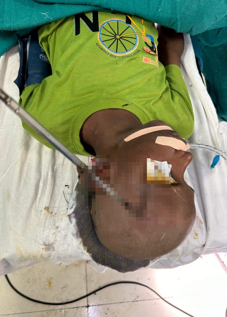 A 14-year-old boy in India miraculously survived after a metal rod pierced his skull. Life-saving surgery removed it with precision, leaving doctors stunned by his recovery.