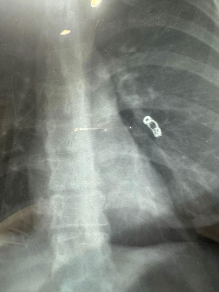 Russian influencer Ekaterina Badulina's common cold symptoms led to a shocking discovery—a metal spring in her lung from past surgery. Read her incredible survival story!