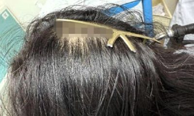 A woman in China had a claw clip embedded in her scalp after being hit by a car. Doctors removed it in 10 minutes, warning of the hidden dangers of hair accessories.