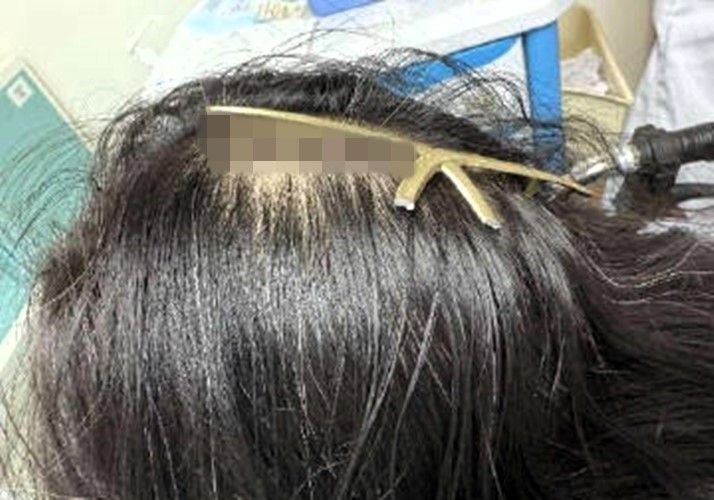 A woman in China had a claw clip embedded in her scalp after being hit by a car. Doctors removed it in 10 minutes, warning of the hidden dangers of hair accessories.