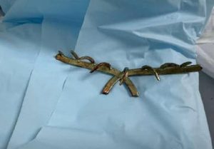 A woman in China had a claw clip embedded in her scalp after being hit by a car. Doctors removed it in 10 minutes, warning of the hidden dangers of hair accessories.